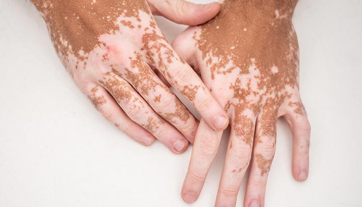 Vitiligo root cause as per Ayurveda