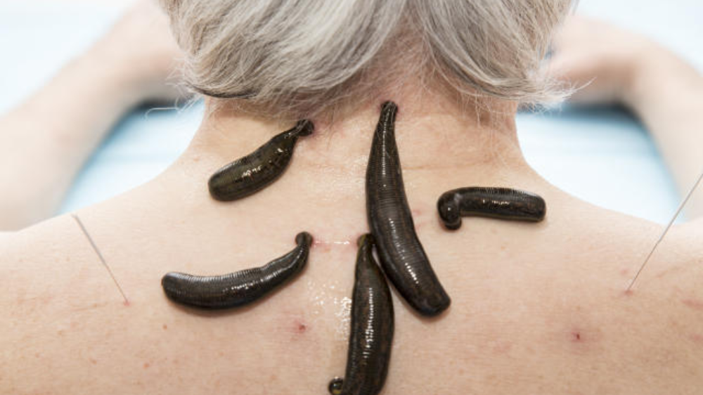 leech therapy being performed for detoxification and circulation improvement