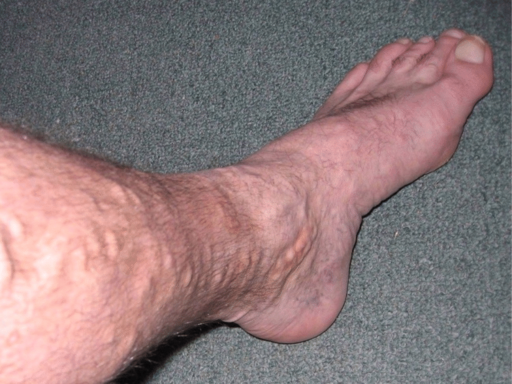 Close-up of swollen varicose veins visible on legs