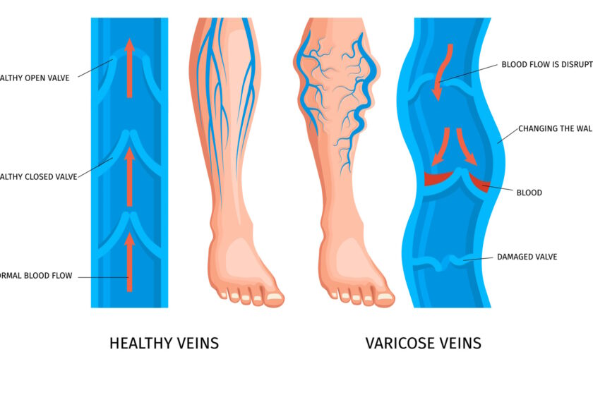 Advanced varicose veins on legs showing swelling and skin changes