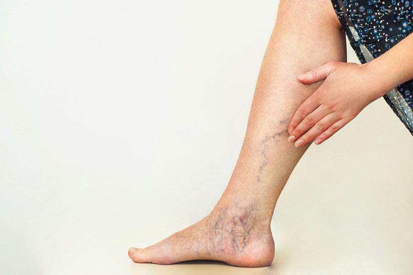 Pregnant woman showing visible varicose veins on legs